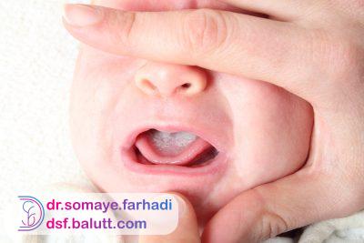 برفک دهان نوزاد چیست؟ راه های درمان آن!